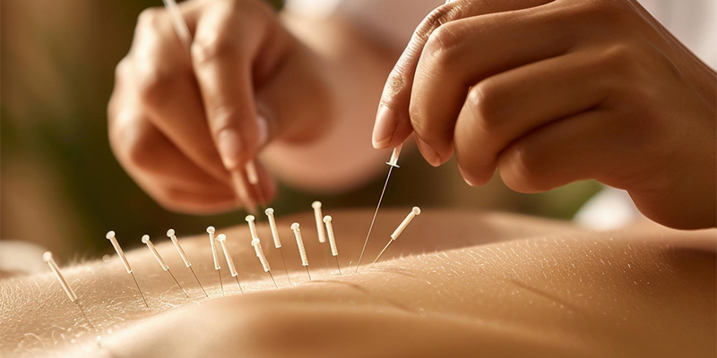 Acupuncture-Treatment