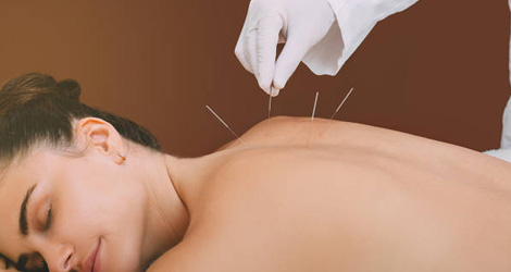 Acupuncture-Treatment