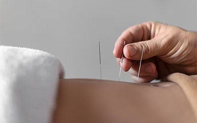 Discover the Healing Power of Acupuncture – A Natural Path to Wellness